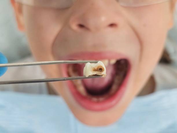 Best Emergency Wisdom Teeth Removal in Kemah, TX